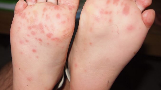 Image for Suggestions for diabetic patients for proper feet care with ID of: 2809855