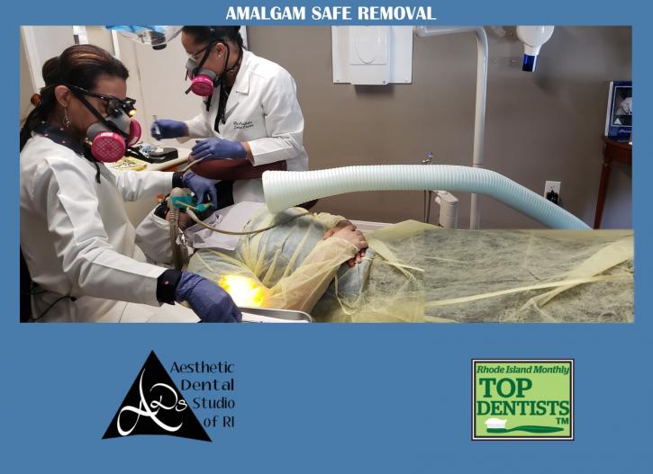 Image for AMALGAM SAFE REMOVAL with ID of: 2857270