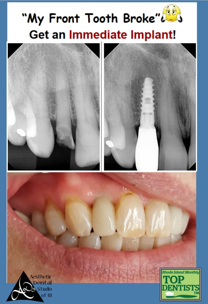 Image for AMALGAM SAFE REMOVAL with ID of: 2857286