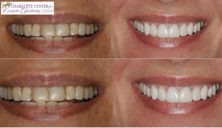 Image for Teeth Whitening with ID of: 2863018