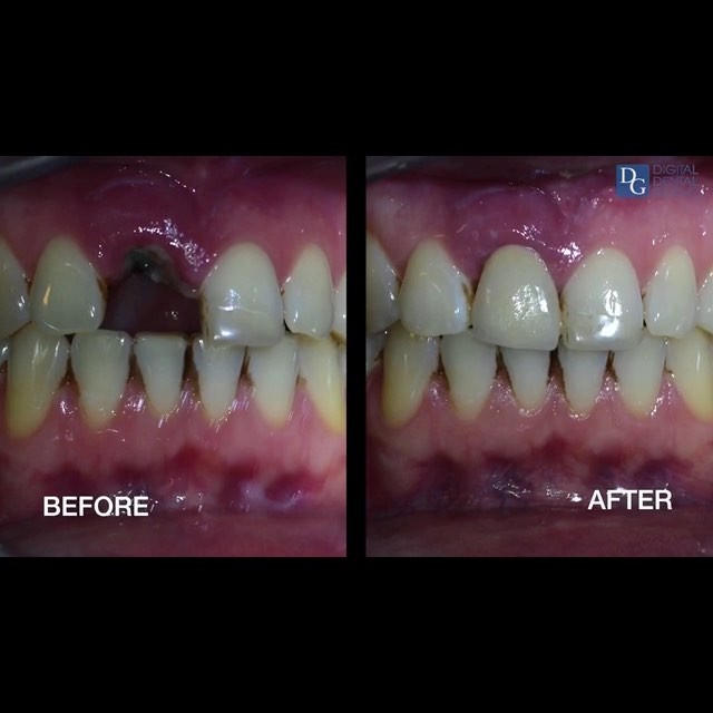 Image for Abutment Dental Elizabeth with ID of: 2874737