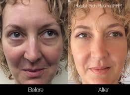 Image for Vampire facial Toronto with ID of: 2905381