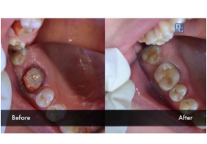 Image for Zirconia Crown Lab with ID of: 2912446