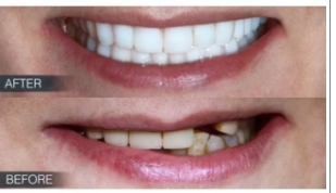 Image for Zirconia Crown Lab with ID of: 2912447