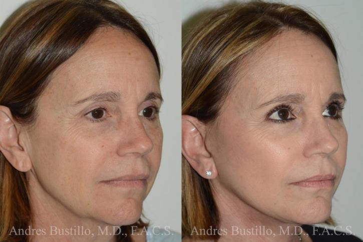 Image for 5 Questions to Ask Yourself Before Getting Cosmetic Surgery with ID of: 2957423