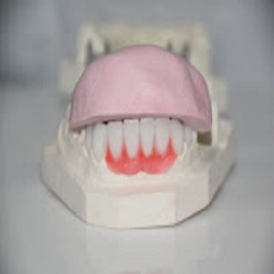 Image for PFM Crown Lab with ID of: 2957555
