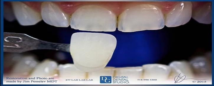 Image for PFM Crown Lab with ID of: 2957556