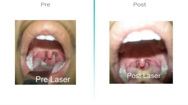 Image for Tonsils with ID of: 2974100