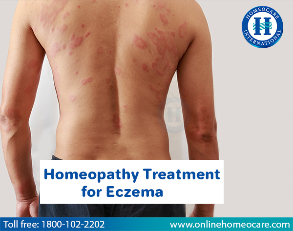 Image for Get Eczema Treated With Homeopathy with ID of: 2982154