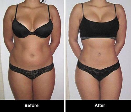 Image for Fat Freeze Treatment with ID of: 2983791