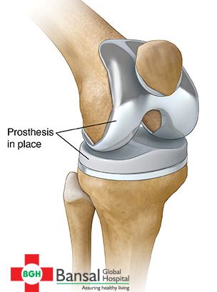 Image for Knee Replacement in Delhi with ID of: 3003904