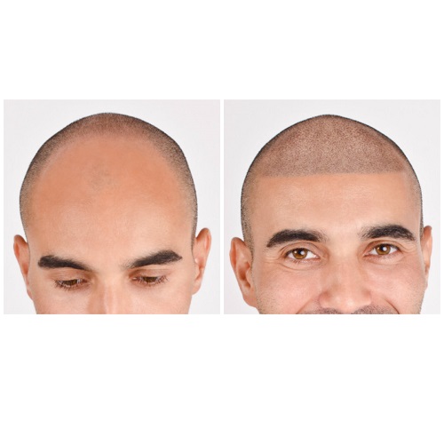 Image for Complete Micropigmentation with ID of: 3028755