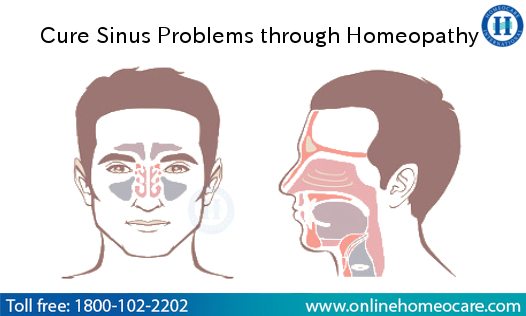Image for Homeopathy Treatment For Sinusitis In Chennai with ID of: 3029541