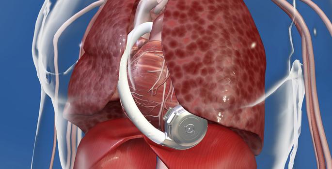 Image for Cardiac Implants Market, By Devices, Application, End User - Global Industry Insights, Trends, Outlook, And Opportunity Analysis, 2018-2026 with ID of: 3036387