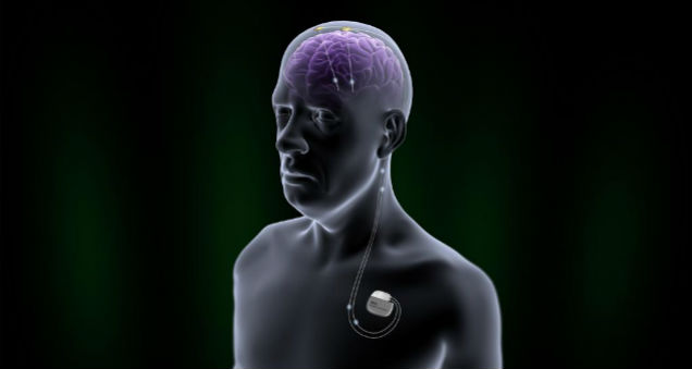 Image for Global Deep Brain Stimulation Devices Market, By Application, and By Geography - Trends, Outlook, and Forecast from 2016-2024 with ID of: 3074284