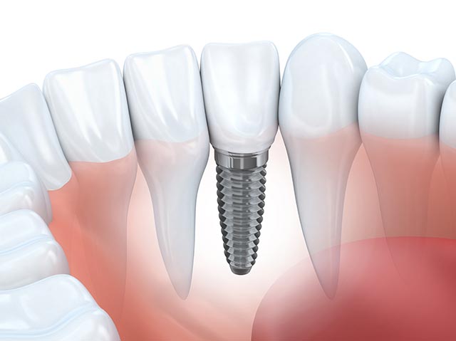 Image for 5 tips for porcelain veneers care with ID of: 3079298