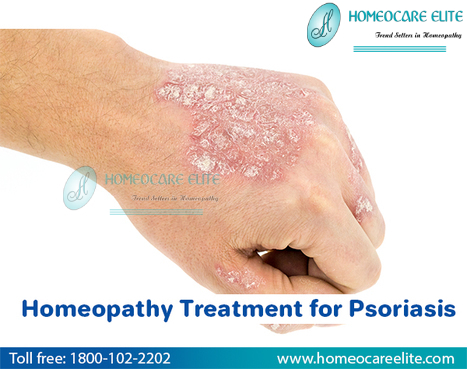 Image for Effective Homeopathy Treatment For Psoriasis with ID of: 3096282