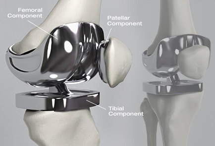 Image for Joint Replacement Devices Market: Industry Growth, Competitive Analysis, Future Prospects and Forecast 2019 with ID of: 3107049