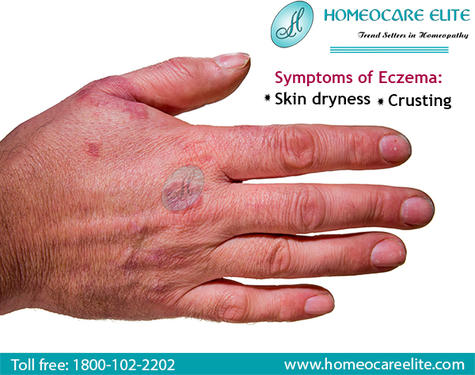Image for Cure Eczema Effectively With Homeopathy with ID of: 3113765