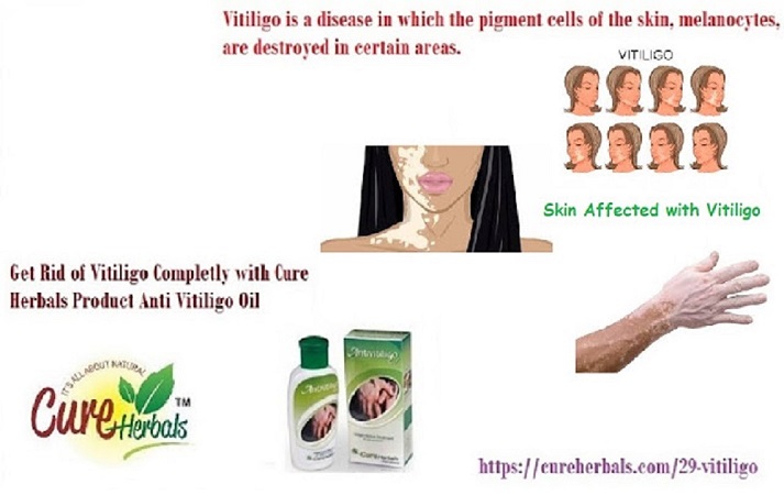 Image for Vitiligo Natural with ID of: 3129066