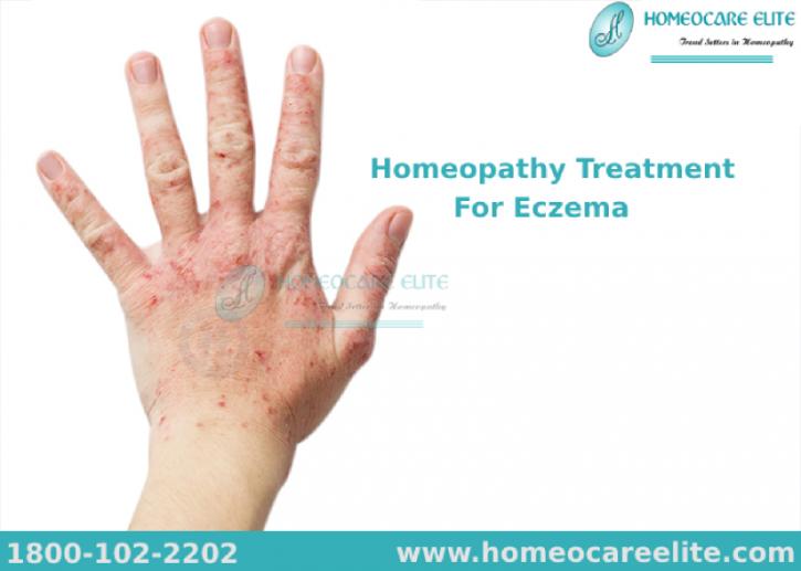 Image for Best Homeopathy Treatment For Eczema with ID of: 3148988