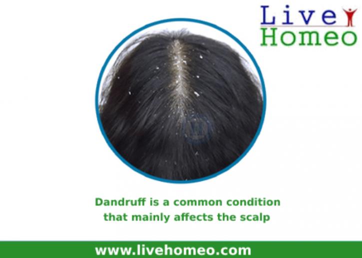 Image for Get Rid Of Dandruff With Homeopathy with ID of: 3156175
