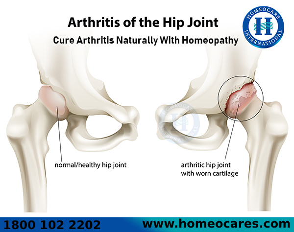 Image for Best Homeopathy Treatment For Arthritis Problem In HSR Layout with ID of: 3176329
