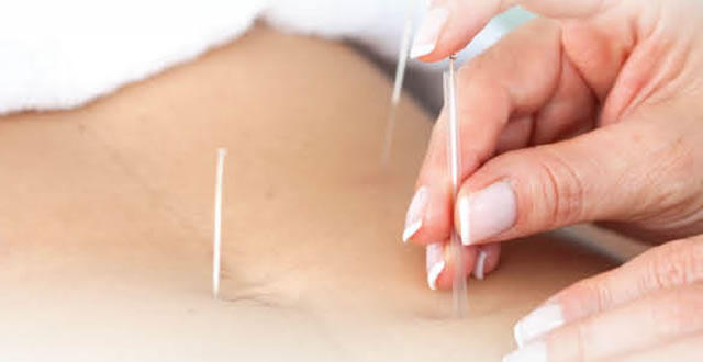 Image for Acorn Acupuncture with ID of: 3182222
