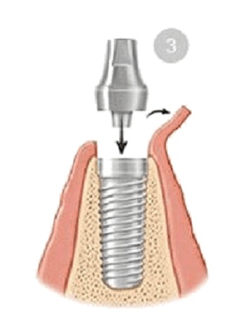 Image for Centers For Dental Implants - Hallandale FL with ID of: 3184701
