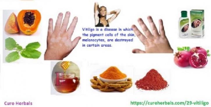 Image for Vitiligo Natural Cure Oils with ID of: 3220849