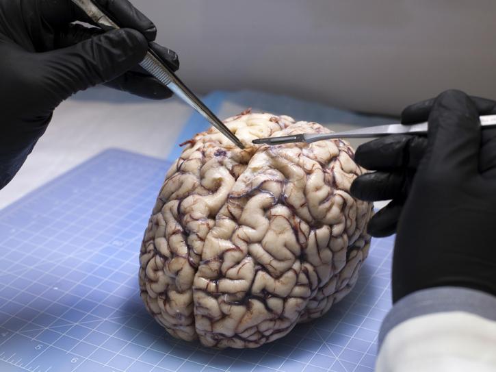 Image for Brain Only Autopsy with ID of: 3234485