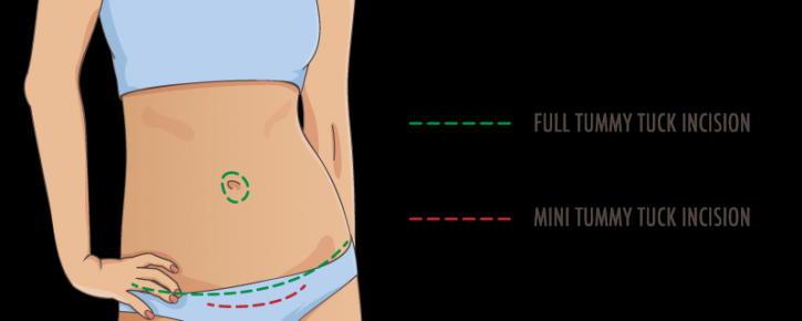 Image for Tummy Tuck Service In Richmond with ID of: 3237534