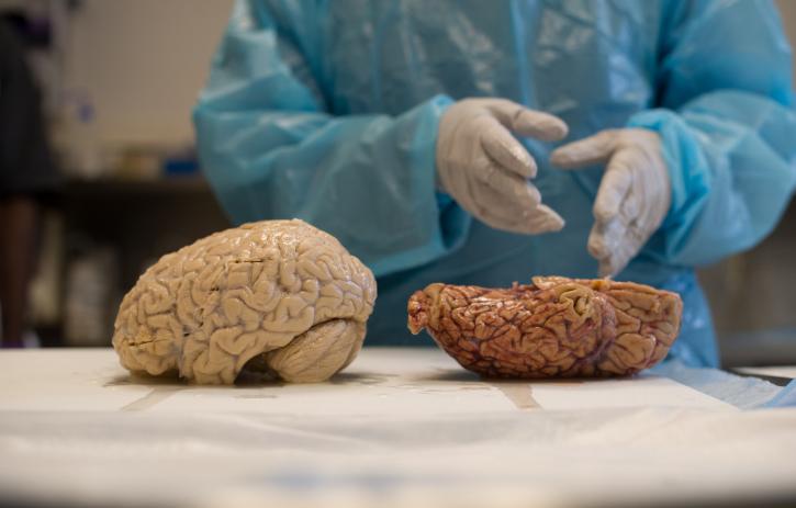 Image for Brain Only Autopsy with ID of: 3253042