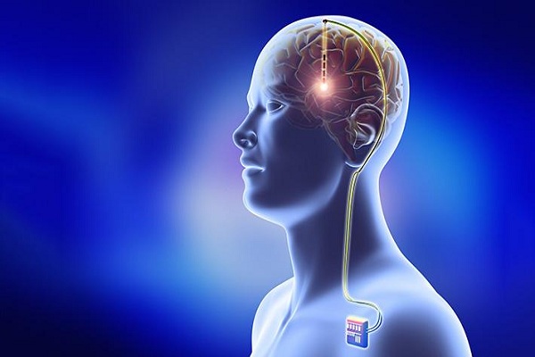 Image for Global Deep Brain Stimulation Devices Market, By Application, and By Geography - Trends, Outlook, and Forecast from 2016-2024 with ID of: 3259858