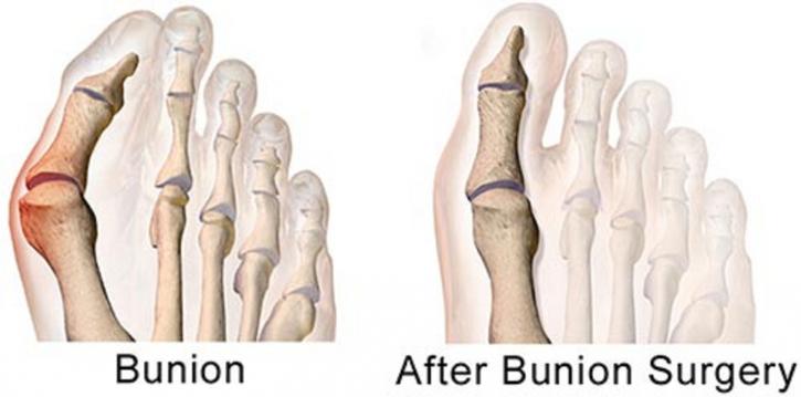 Image for Bunion Surgery Specialists with ID of: 3261661