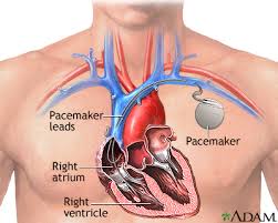 Image for Check Pacemaker Surgery Cost in India - Credihealth with ID of: 3264668