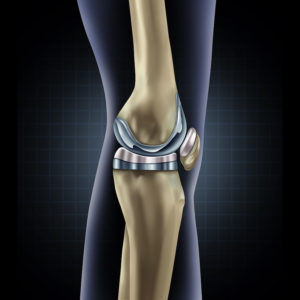 Image for Knee Implants Market - Size, Share, Outlook, and Opportunity Analysis, 2018-2026 with ID of: 3286473