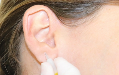 Image for Auriculopuncture Multiple Sclerosis treatment in Spain with ID of: 3297981
