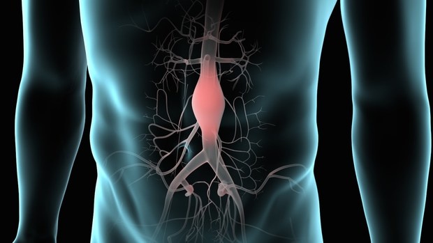 Image for Abdominal Aortic Aneurysm Repair Devices Industry: Study Growth Factors, Types and Applications with Market Forecasts 2026 with ID of: 3305462