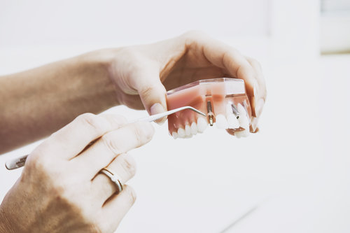 Image for Replace your damage tooth at Tooth Replacement Irving Texas office. with ID of: 3308563