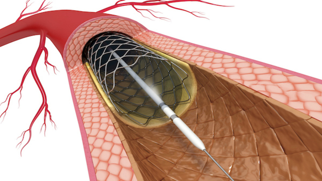 Image for Bio-engineered Stent Market Global Industry Size, share, Outlook, and Forecast 2018-2026 with ID of: 3365675