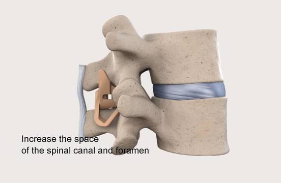 Image for Interspinous Process Decompression Devices Market - Size, Share,and Analysis 2018–2026 with ID of: 3380622