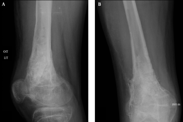 Image for Antibiotic Bone Cement and Casting Materials Market at a Rapid Pace Until  2026 with ID of: 3388784