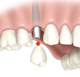 Image for Affordable Dental Implants Albany with ID of: 3394252