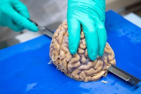 Image for Brain Only Autopsy with ID of: 3409903