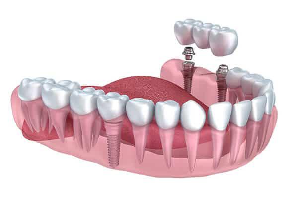 Image for Intramucosal Implants Market: Industry Quantitative and Qualitative Insights into Present and Future Development Prospects to 2026 with ID of: 3412235