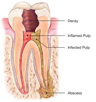 Image for Root Canal Treatment with ID of: 3412362