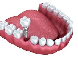 Image for Walk In Dentist No Insurance with ID of: 3414091
