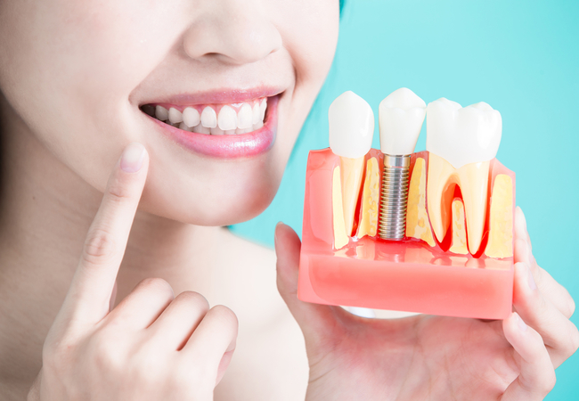Image for Dental Implants Market- Trend, Analysis and Forecast till 2026 with ID of: 3432155