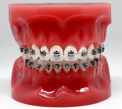 Image for Self Ligating Bracket Sales Market Study By Type, Application & Top Key Players - BioMers Pte Ltd., Orthodontic Products, G&H® Orthodontics, Ormco Corporation with ID of: 3442852